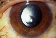 Intervencion de cataratas con introduccion de lente multifocal