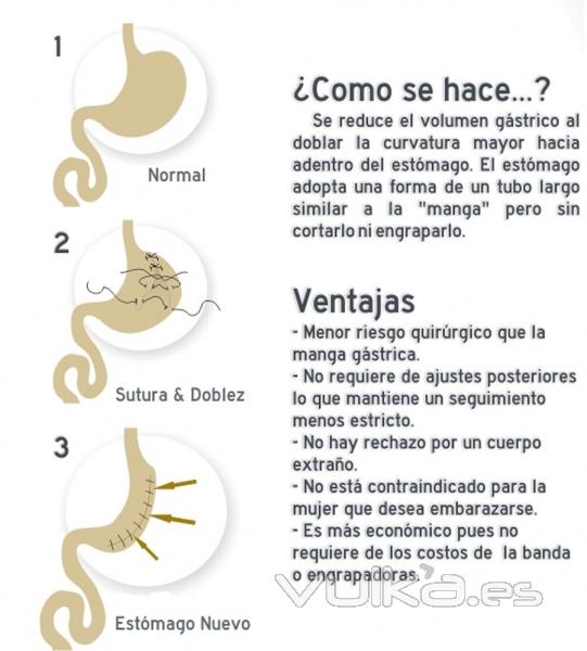 Reduccin de estmago sin extirpar parte del mismo: PLICATURA GASTRICA