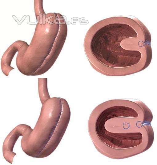 PLICATURA GASTRICA
