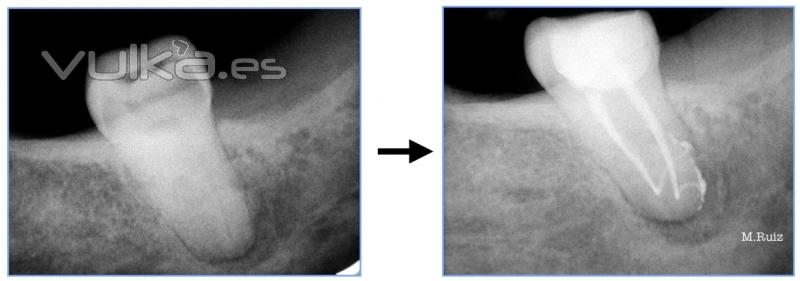 endodoncia de molar con gran curvatura 3