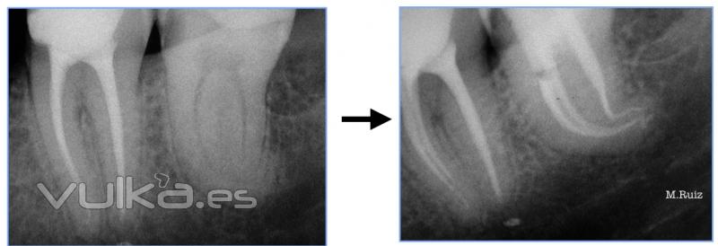 endodoncia de molar con gran curvatura 2