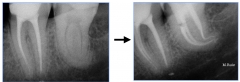 Endodoncia de molar con gran curvatura 2