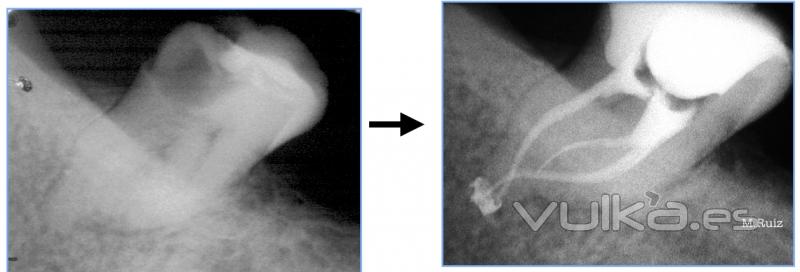 endodoncia de molar con gran curvatura