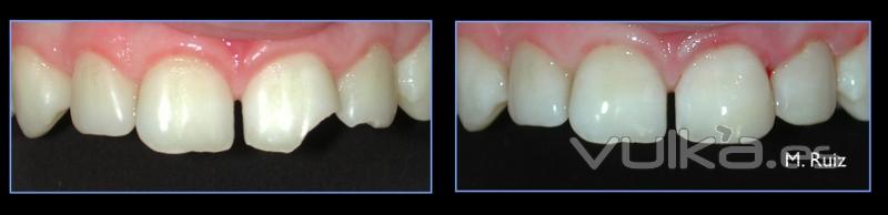 Carilla de composite para solucionar una fractura en un incisivo