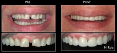 Carillas de ceramica para cerrar un diastema