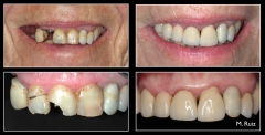 Coronas ceramicas e implantes solucionando un traumatismo anterior