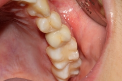 Foto 13 prtesis dentales en Valencia - Clinica Dental Lluch
