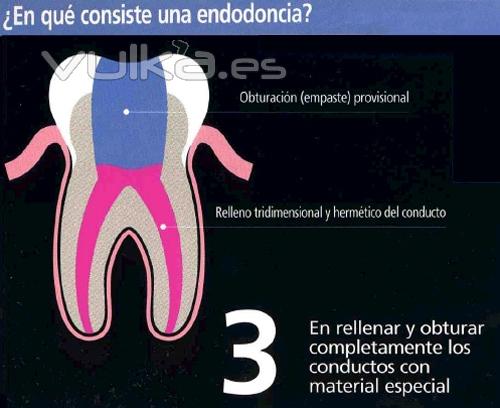 ¿En qué consiste una endodoncia? (3)