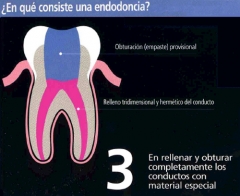 ¿en que consiste una endodoncia (3)