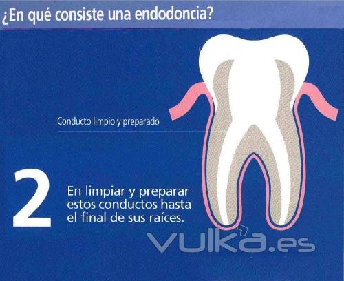 ¿En qué consiste una endodoncia? (2)