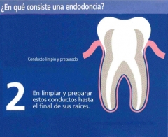 ¿En qué consiste una endodoncia? (2)