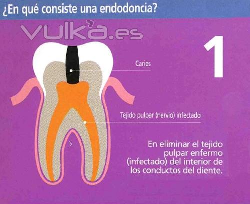 En qu consiste una endodoncia? (1)