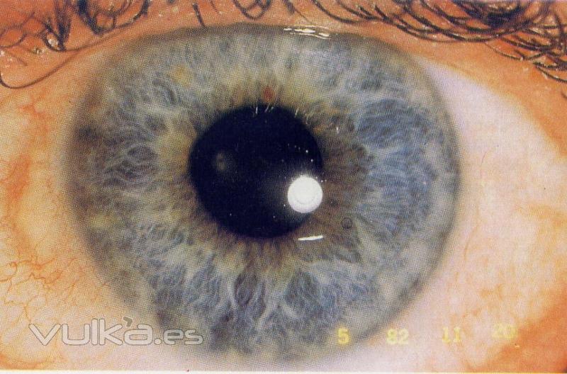iridologia ( Dr. Fsc Xavier Forns i Balcells)
