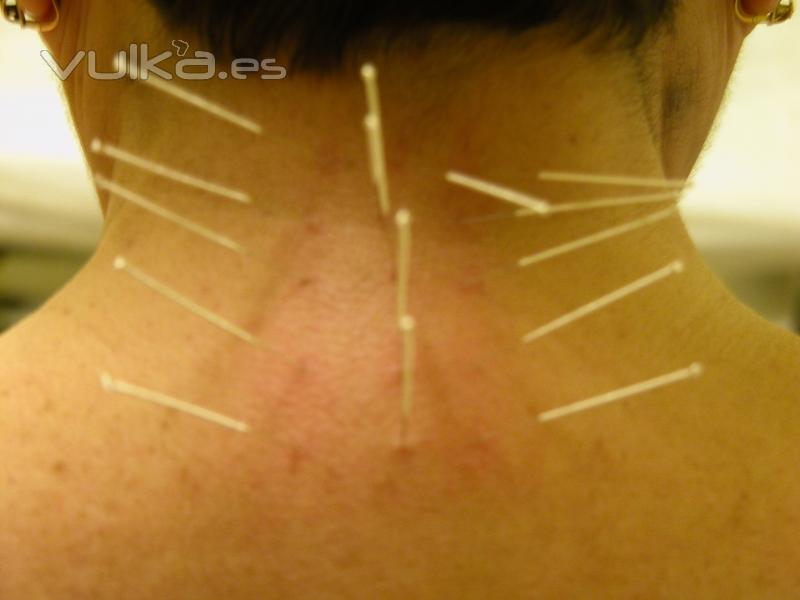 Acupuntura-tractament axial cervical ( foto Dr. Fsc. Xavier Forns i Balcells)