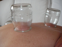 Tractament amb ventoses domestiques (foto dr fsc xavier forns i balcells)