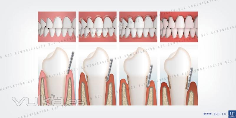 ILUSTRACION DIENTES ENFERMEDADES PERIODONTAL