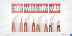 Ilustracion dientes enfermedades periodontal