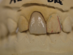 Foto 48 prótesis dentales en Valencia - Laboratorio Dental Marzal