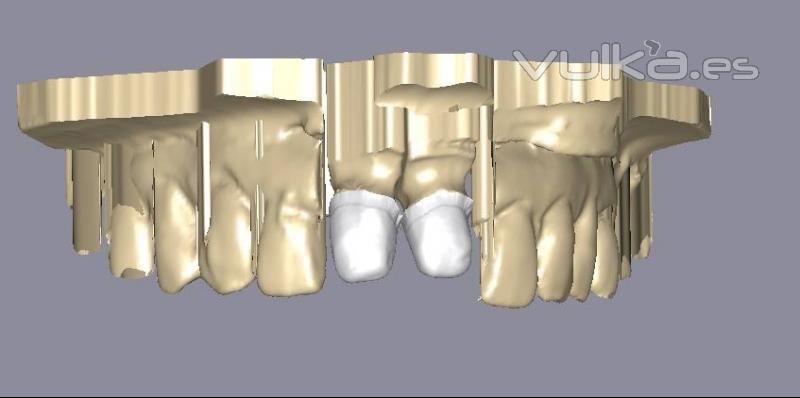 DISEÑO CON CAD/CAM ZIRCONIO