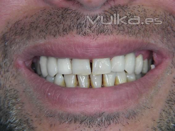 FINALIZACION EN ZIRCONIO CERAMICA