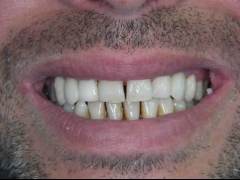 Finalizacion en zirconio ceramica