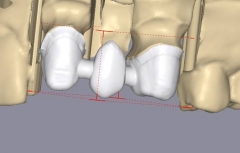 Diseno de la estructura con escaner straumann cad-cam
