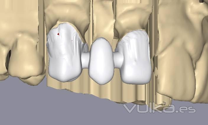 DISEO DE LA ESTRUCTURA CON ESCANNER STRAUMANN CAD-CAM