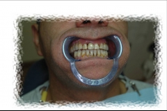 Finalizacion coronas metal ceramica en boca
