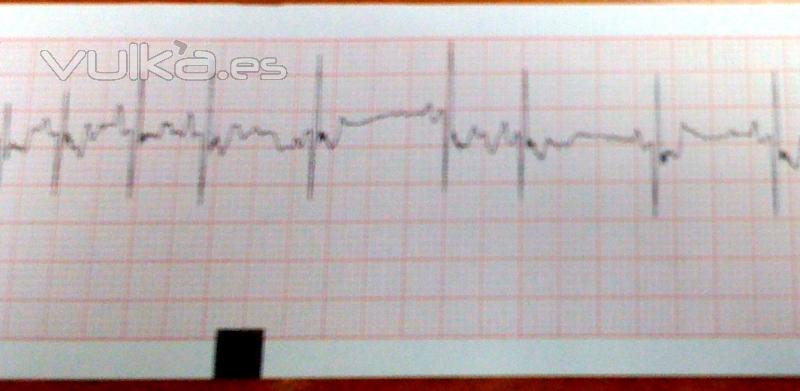 Electrocardiograma que muestra alteracin en la conduccin.