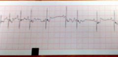 Electrocardiograma que muestra alteracin en la conduccin.