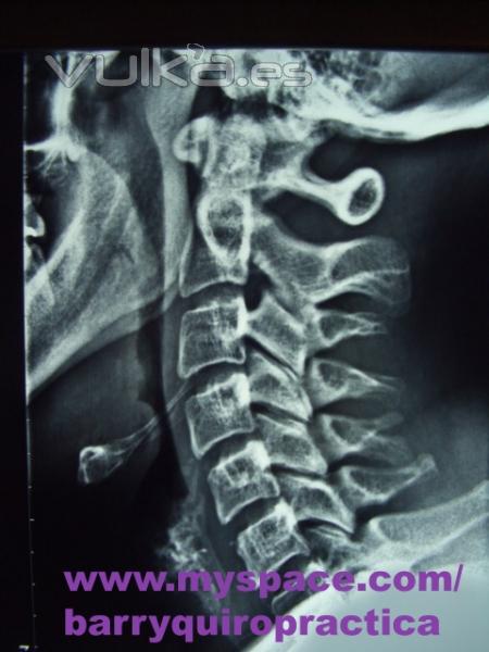 Centro Barry Quiropractica Bilbao-Radiografia columna cervical