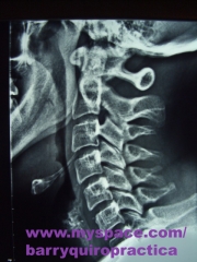Centro barry quiropractica bilbao-radiografia columna cervical
