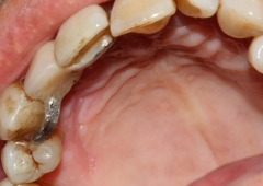 Foto 13 endodoncia en Valencia - Clinica Dental Lluch