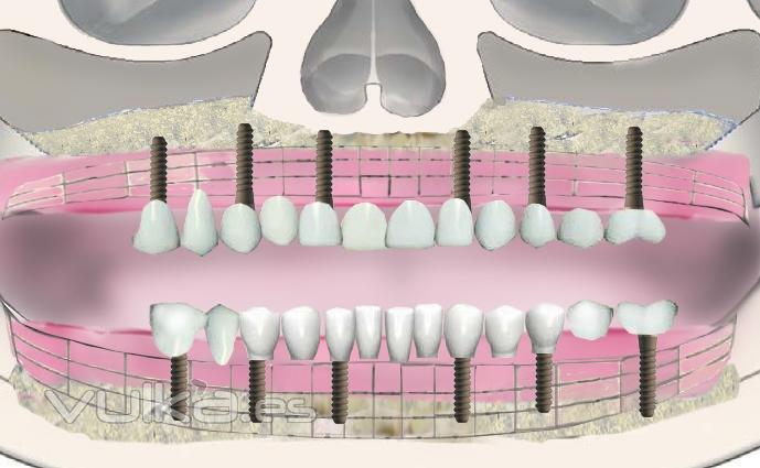 Implantes dentales, la solucin a la falta de dientes