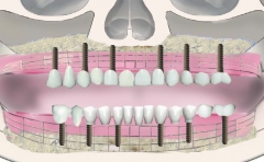 Implantes dentales, la solucion a la falta de dientes