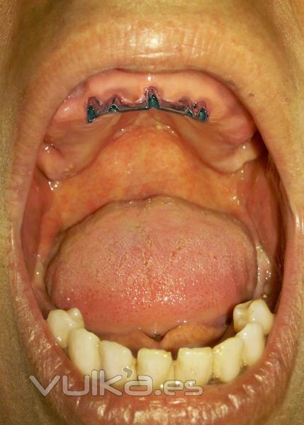 Implantes en forma de barra para sobre dentaduras