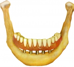 con 4 implantes tenemos dentadura sin problemas