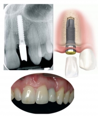 Implantes dentales de i3 Clinica del Doctor Bazán