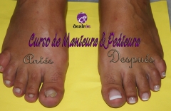 Pedicura_antes_despues