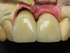 Coronas metal ceramica sobre implantes ferulizadas