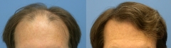 Casos (antes y despues) wwwrecuperaciondelpelocom