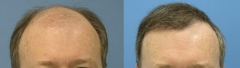 Casos (antes y despues) wwwrecuperaciondelpelocom