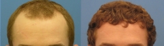 Casos (antes y despues) wwwrecuperaciondelpelocom