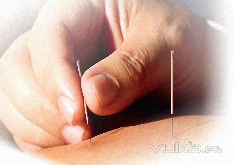 Acupuntura, Terapia de la Ansiedad, Ciatica