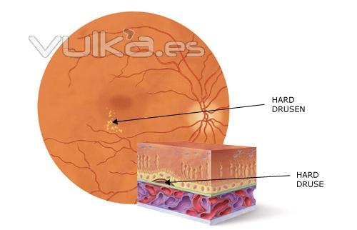 ESQUEMA DE FORMACION DE DRUSAS EN RETINA