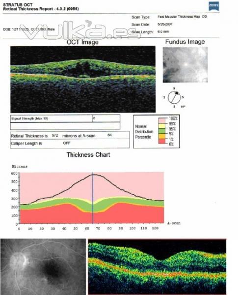 edema de macula visto con OCT