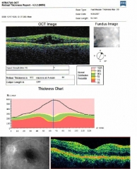 Edema de macula visto con oct