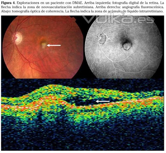 degeneracion macular, 3 puntos de vista