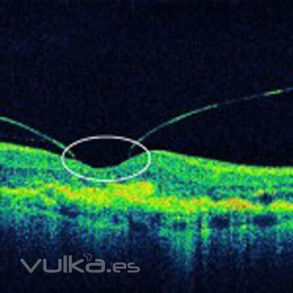 membrana epiretiniana que precisar cirugia