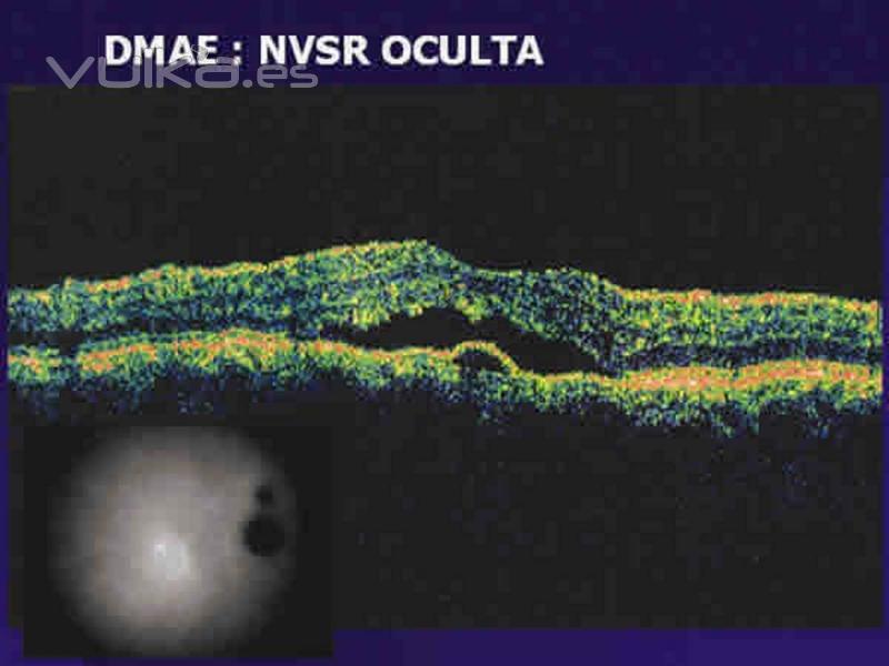 membrana neovascular en DMAE